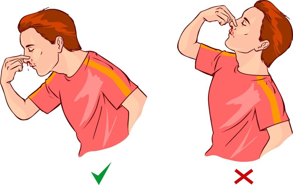 Epistaxis hipertenzijai
