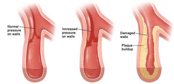 Sergant hipertenzija, pažeidžiamas kraujagyslių lovos praeinamumas